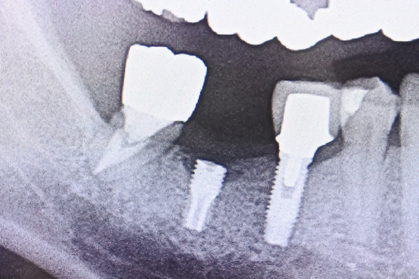 インプラントのベースから折れてしまう非常に珍しいケース インプラントのベースから折れてしまう非常に珍しいケース